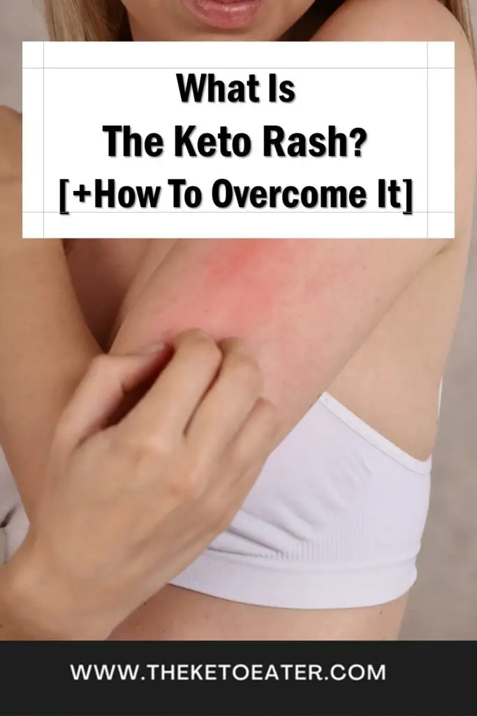 keto rash explained how to prevent and overcome it cures