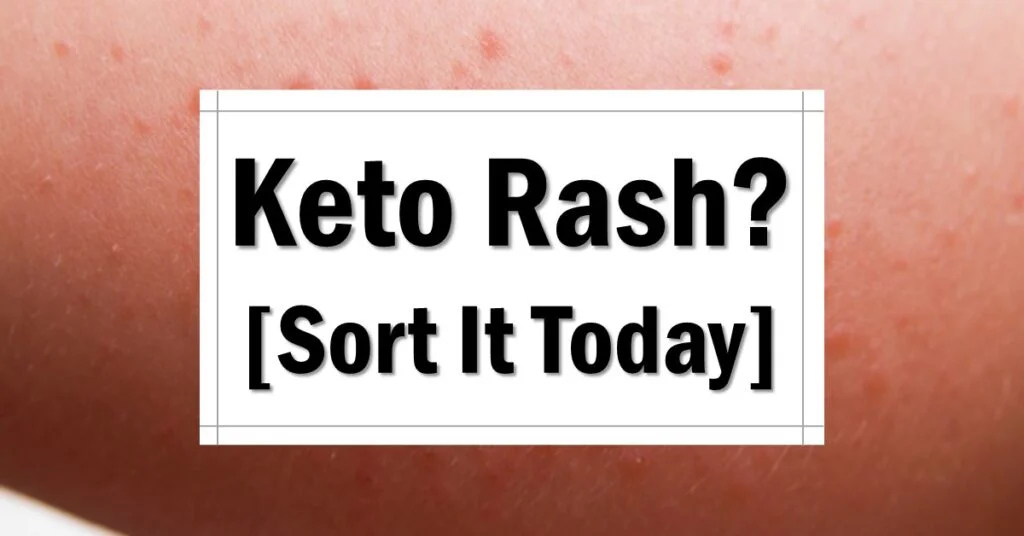 what-is-keto-rash-and-how-to-get-rid-of-it