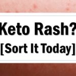what-is-keto-rash-and-how-to-get-rid-of-it